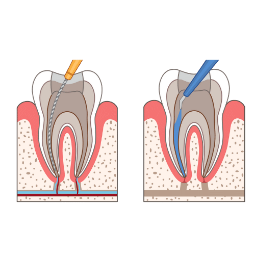 Root Canal 5 Step 2: Cleaning and shaping