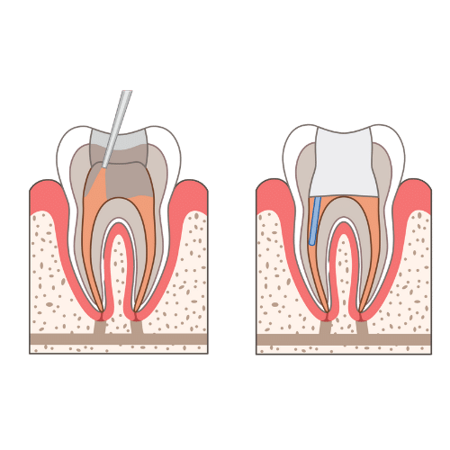 Root Canal 6 Step 3: Sealing and temporary filling