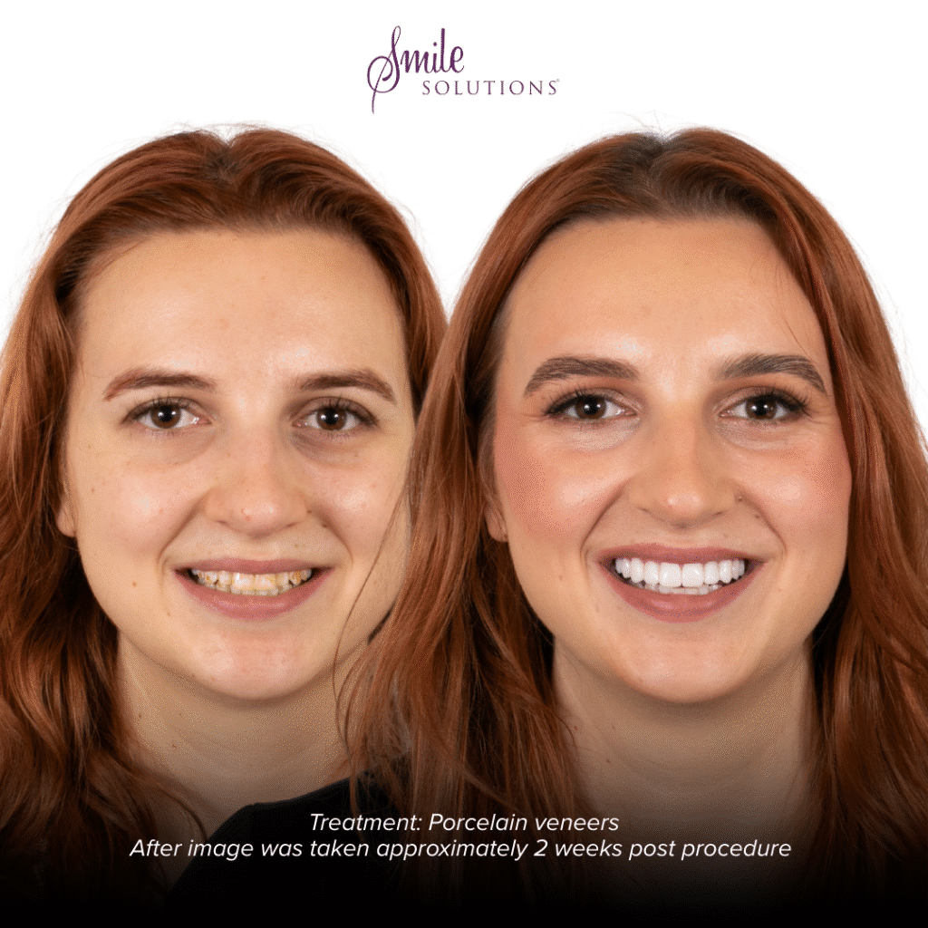 Porcelain Veneers Smile Solutions