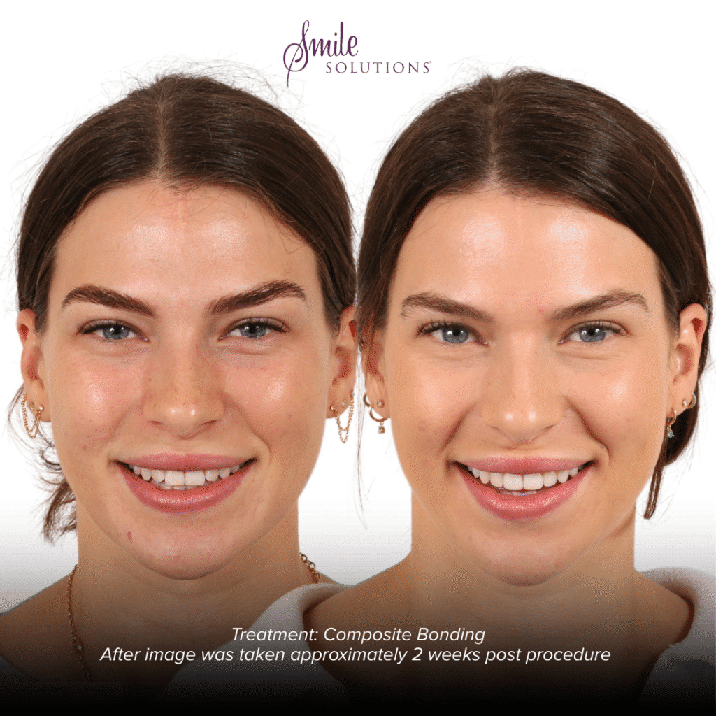 Composite Veneers Smile Solutions