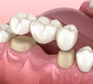 Conventional dental bridge