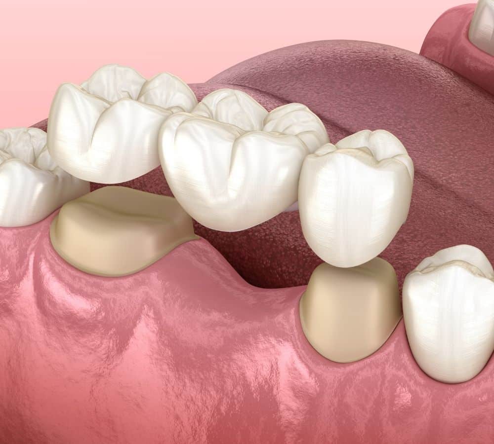 Conventional bridges