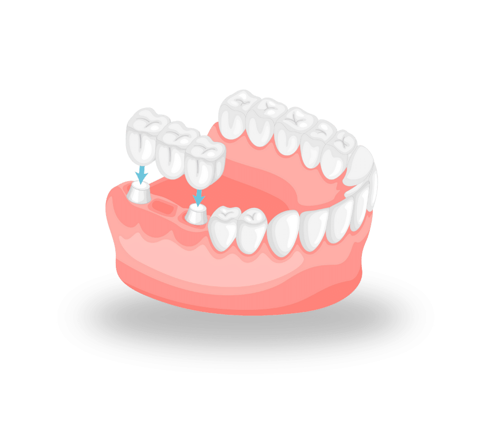Dental Bridges