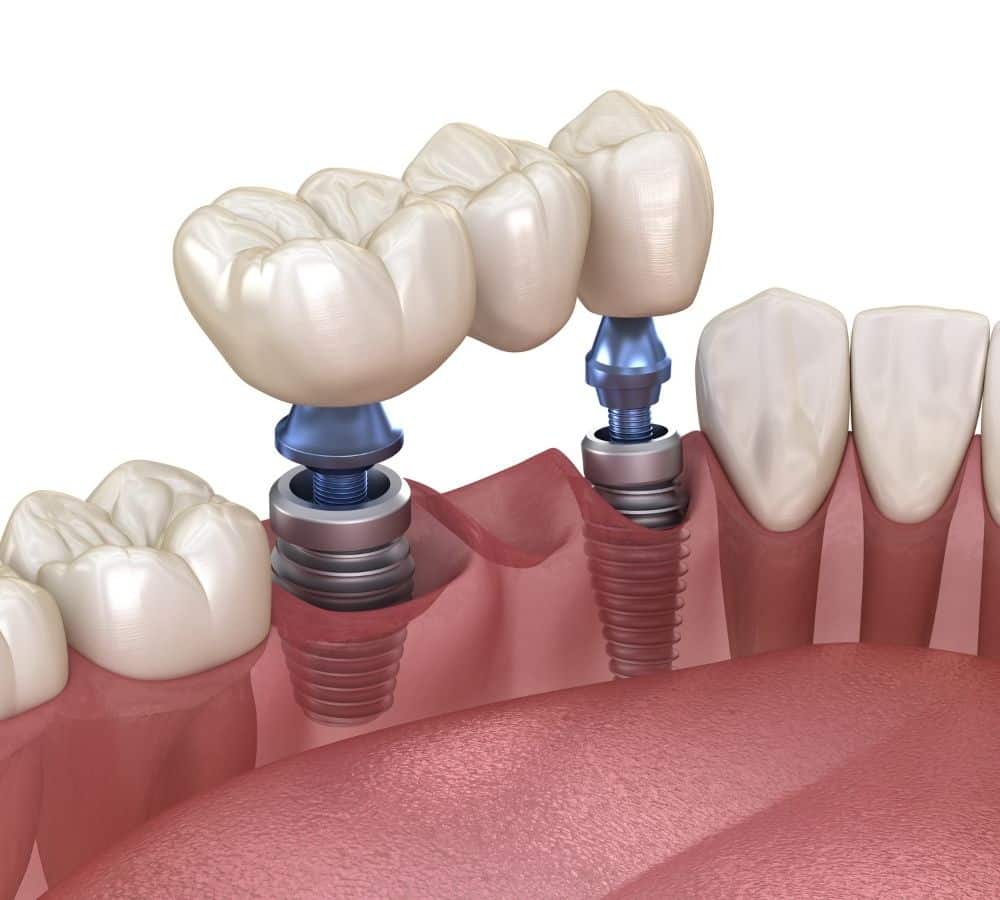 Implant-supported bridges