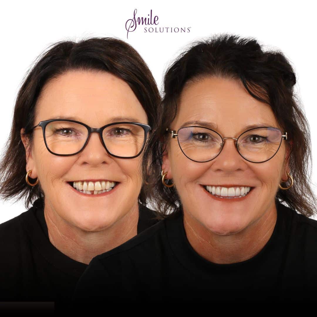 All-on-4® Dental Implants 5 Smile I 1