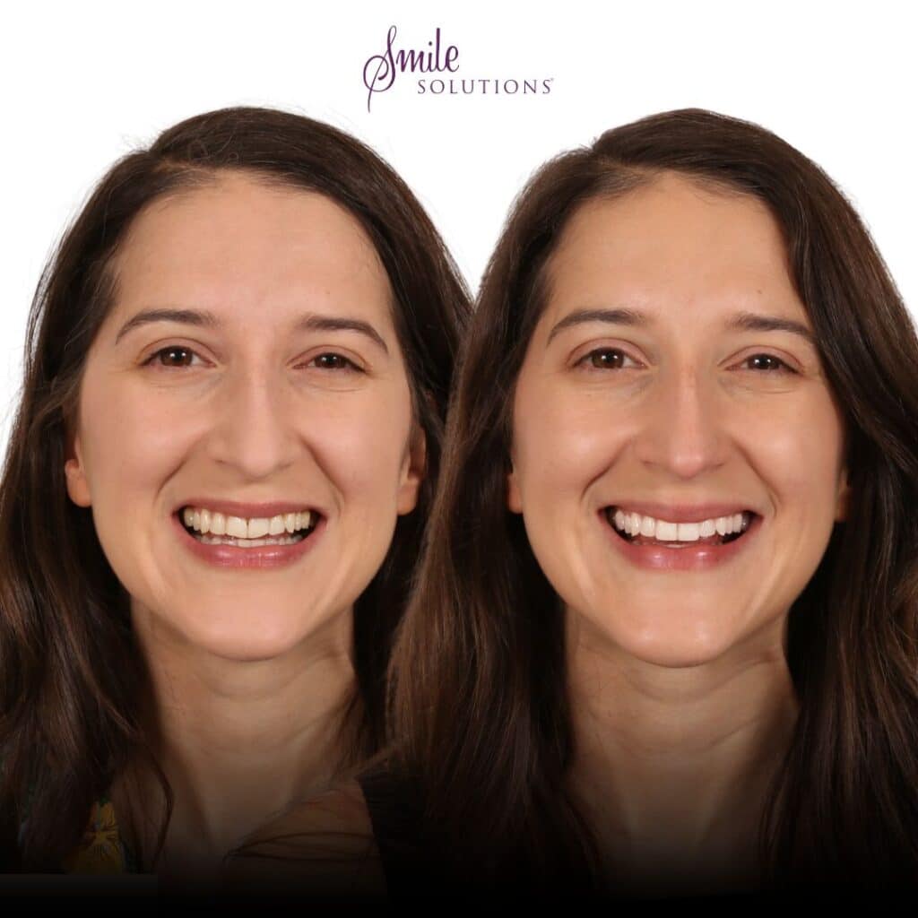 Edge Work Composite Bonding 4 Smile CB