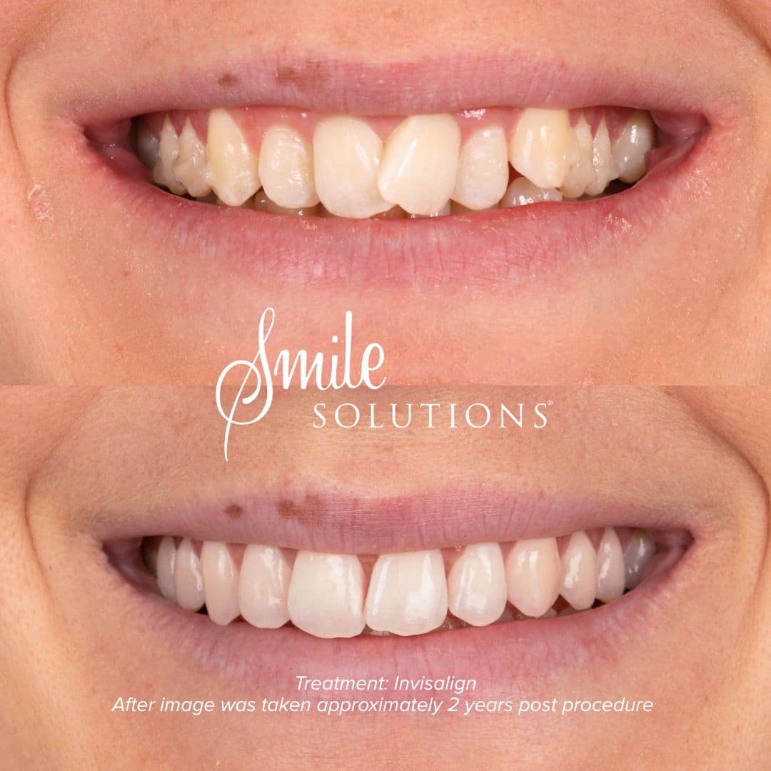 Complimentary Orthodontic Consultation 4 246
