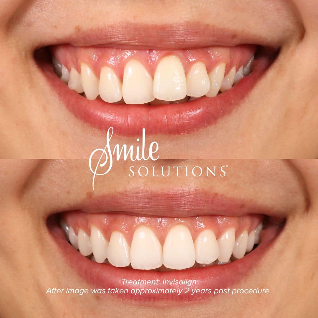 Complimentary Orthodontic Consultation 6 249