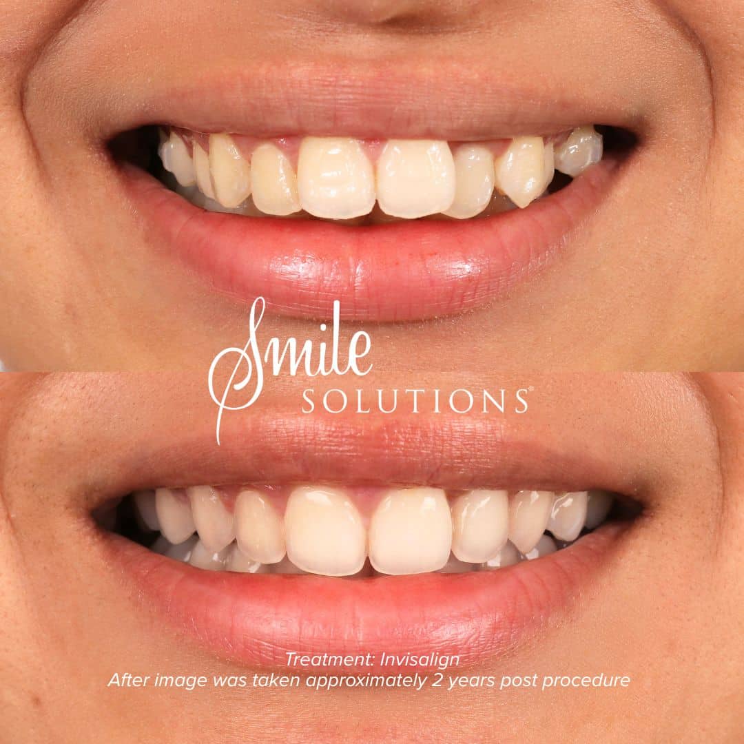 Complimentary Orthodontic Consultation 8 252