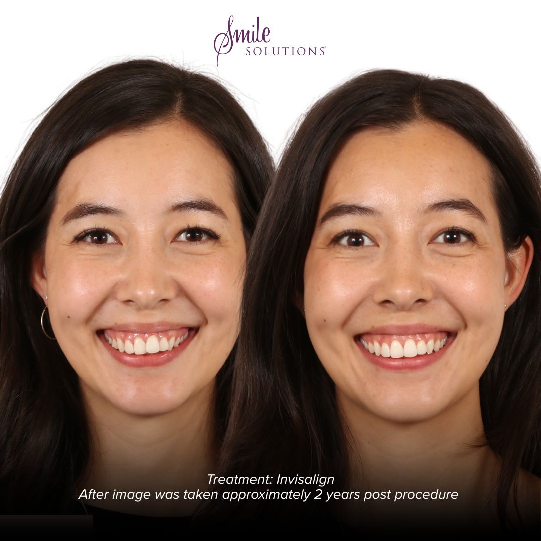Complimentary Orthodontic Consultation 5 Smile I 2
